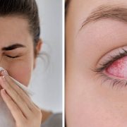 Cosa fare in caso di rinite e congiuntivite allergica