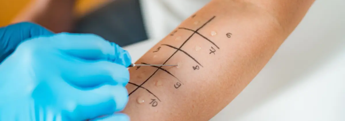 Test allergologici guida completa agli esami per individuare ogni tipo di allergia