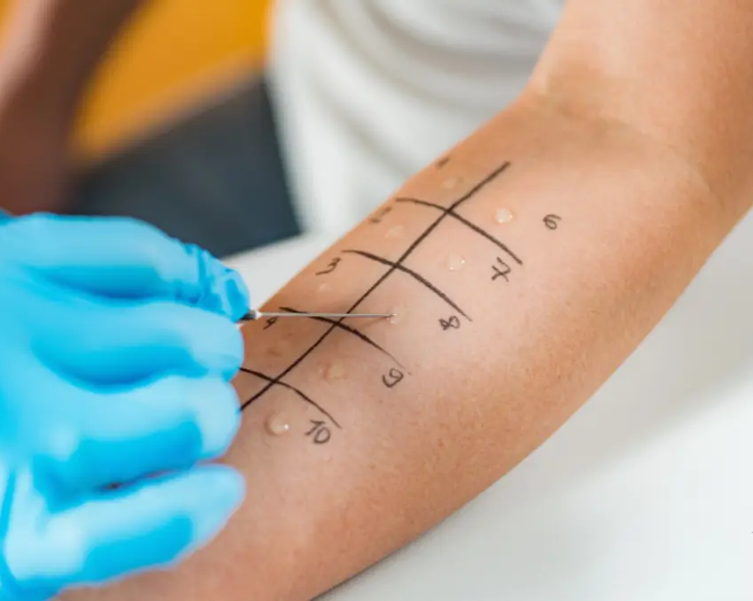 Test allergologici guida completa agli esami per individuare ogni tipo di allergia